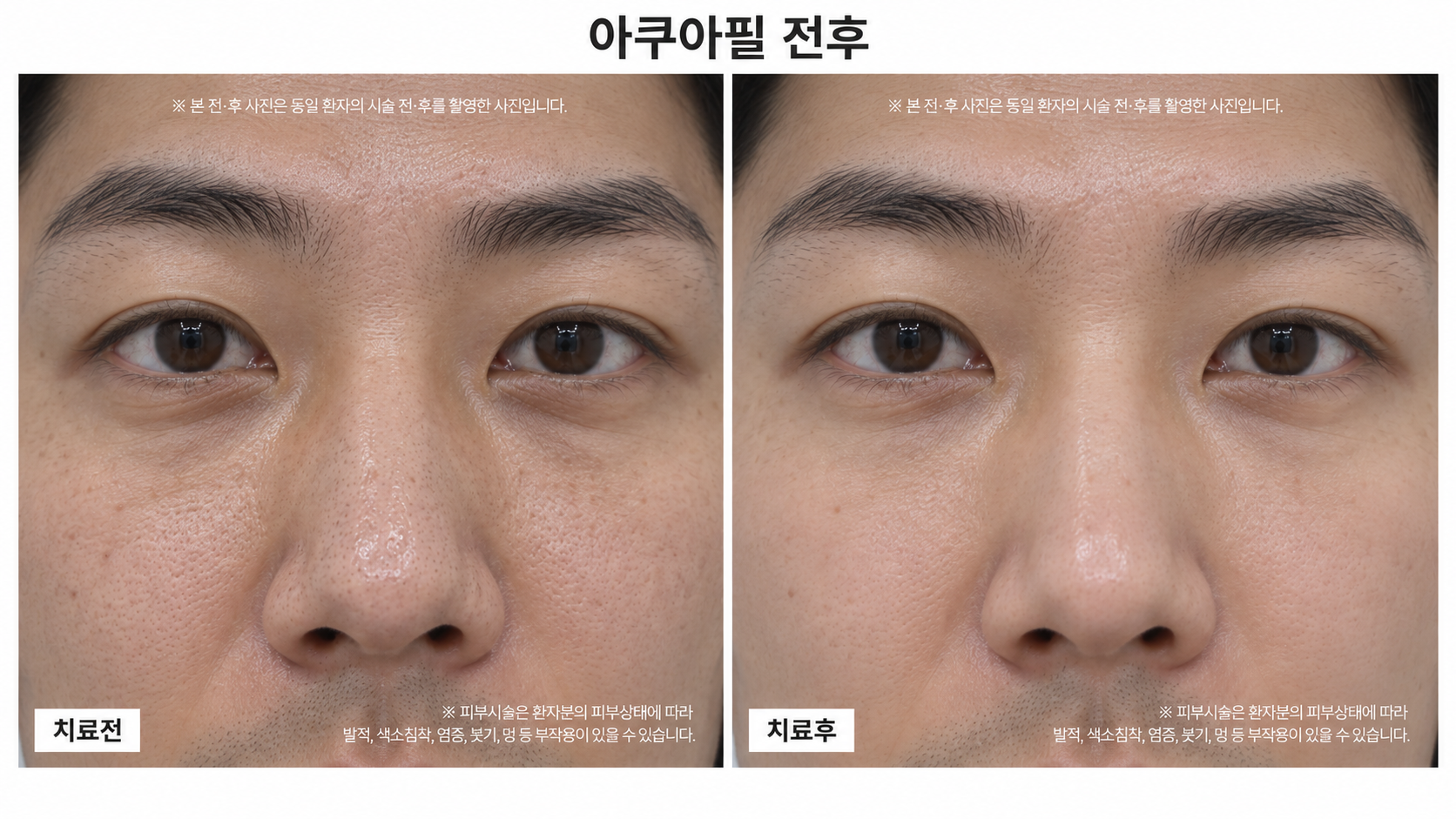 아쿠아필 관리 전후사진