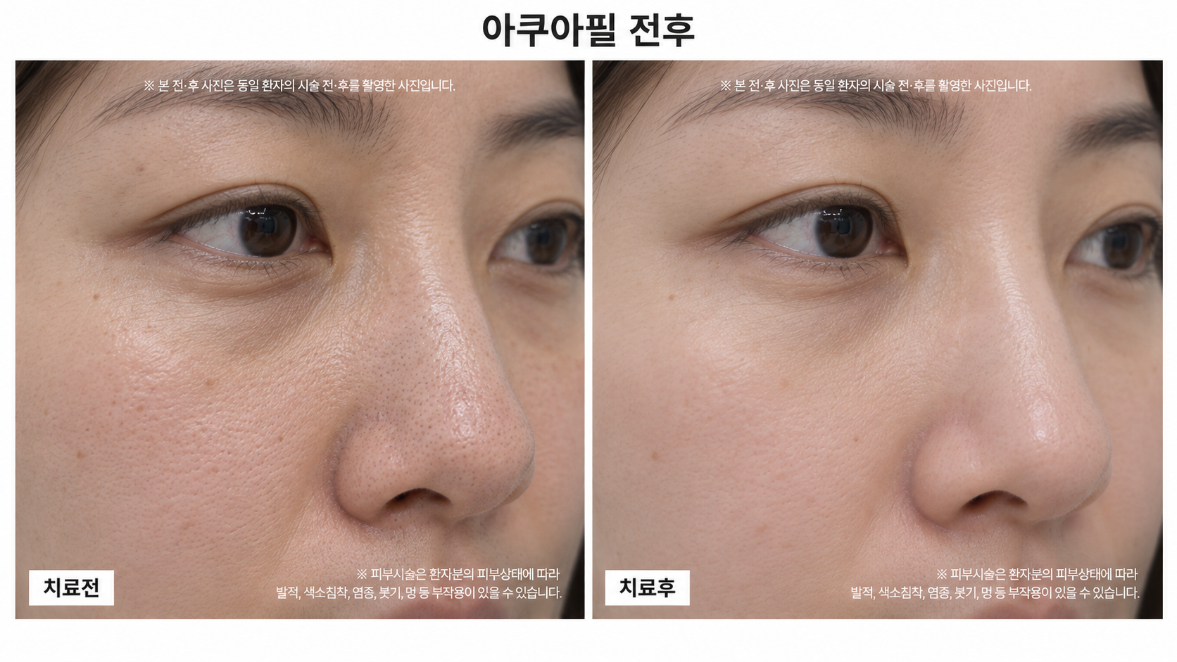 아쿠아필 관리 전후사진