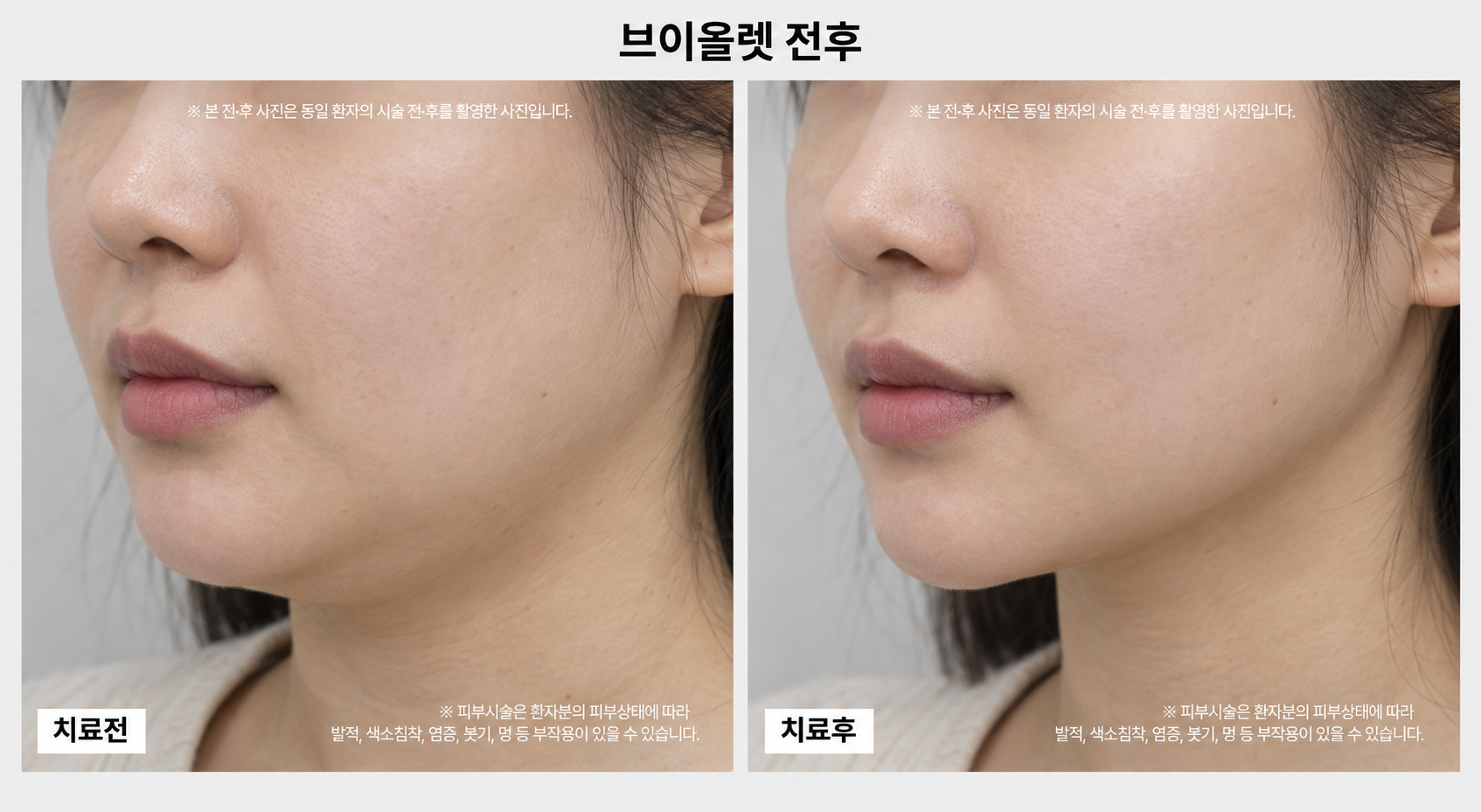 지방분해주사 전후사진