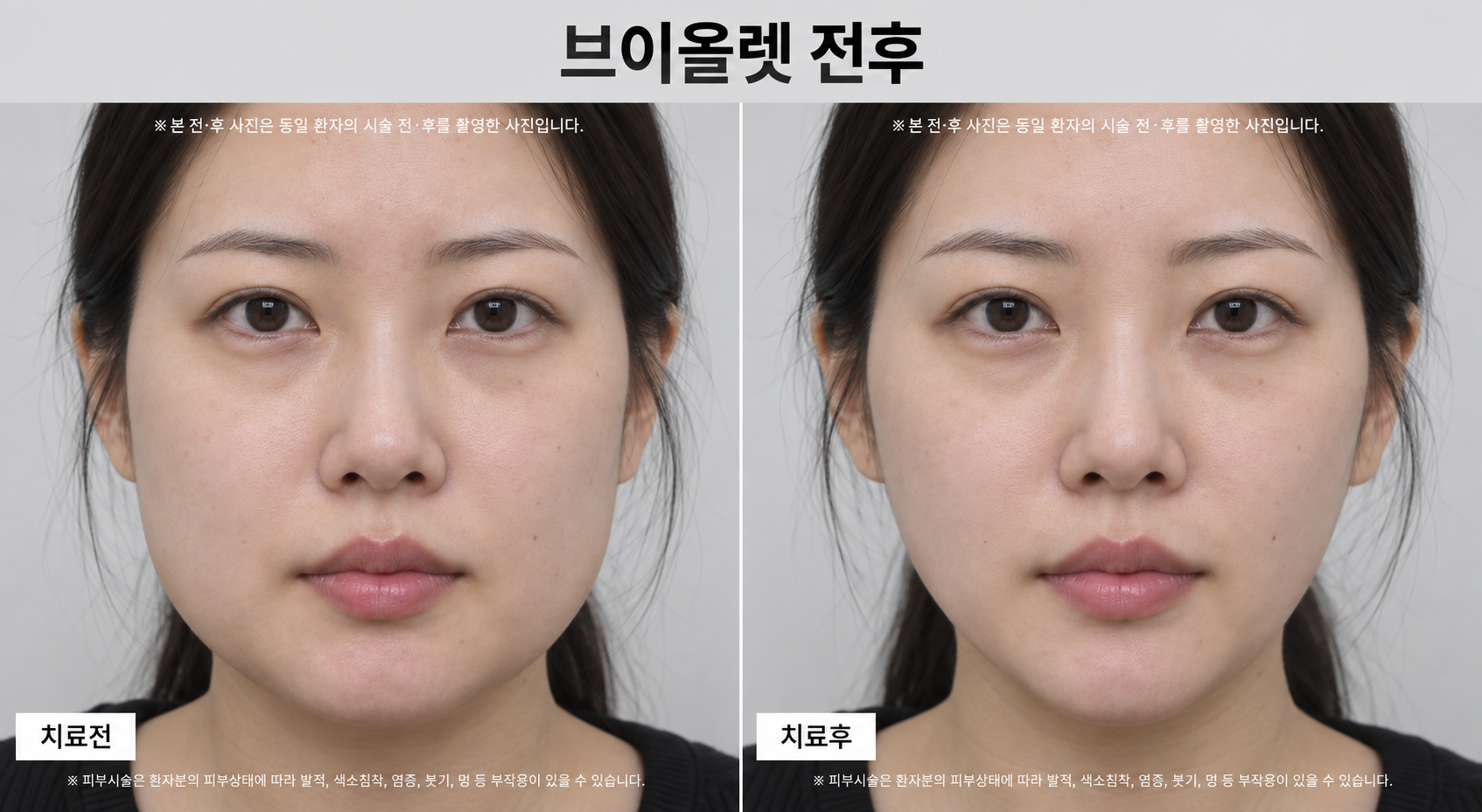 지방분해주사 전후사진
