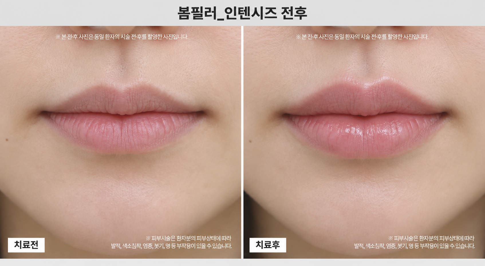 필러 시술 전후사진