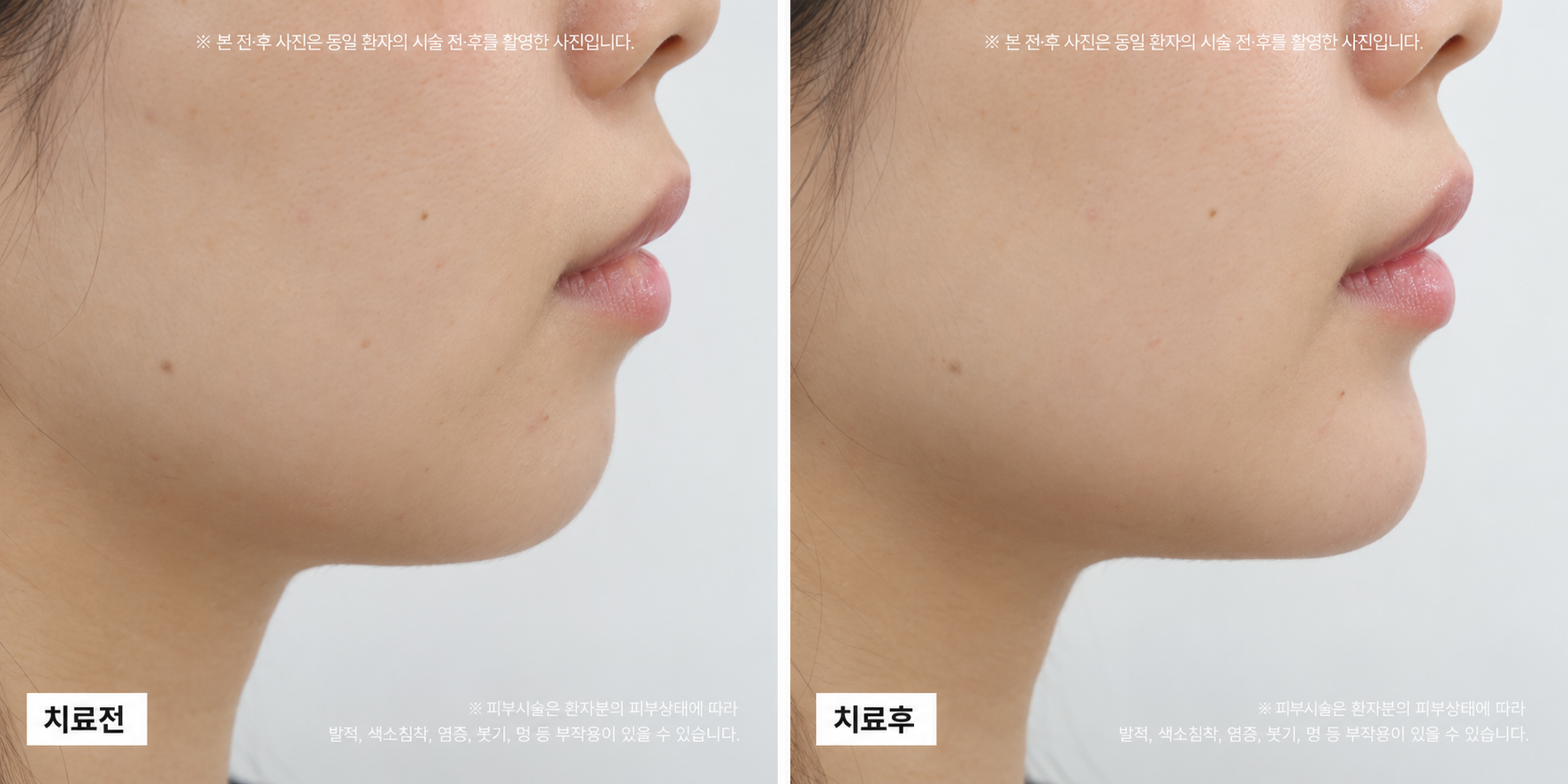 턱끝필러 전후사진