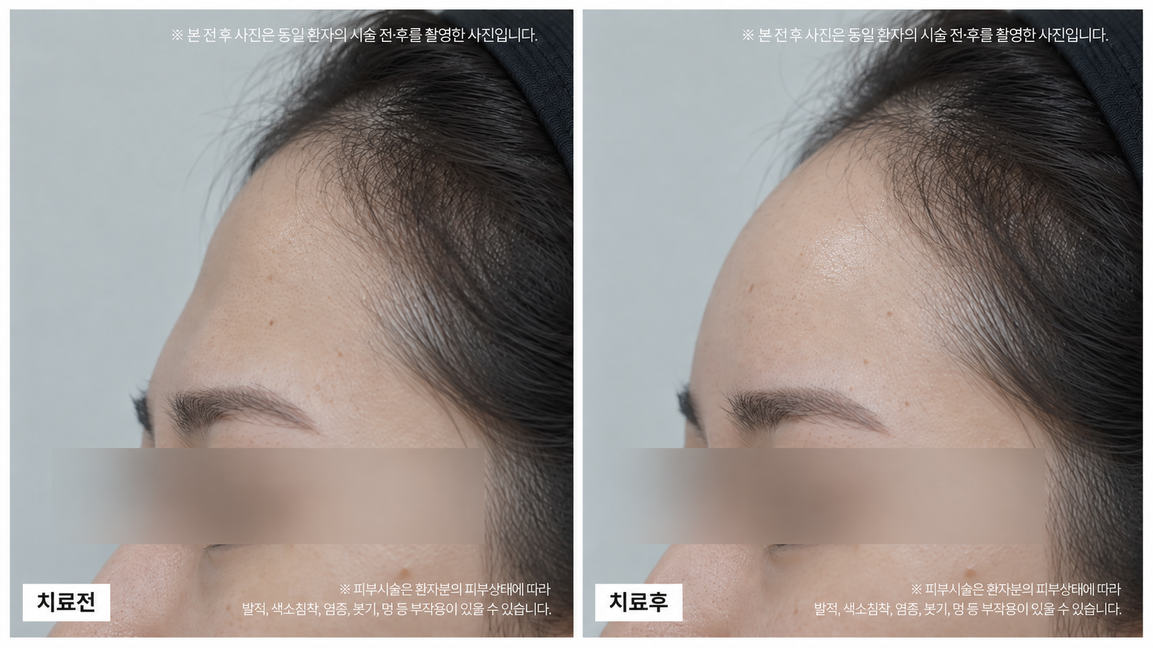 이마필러 전후사진