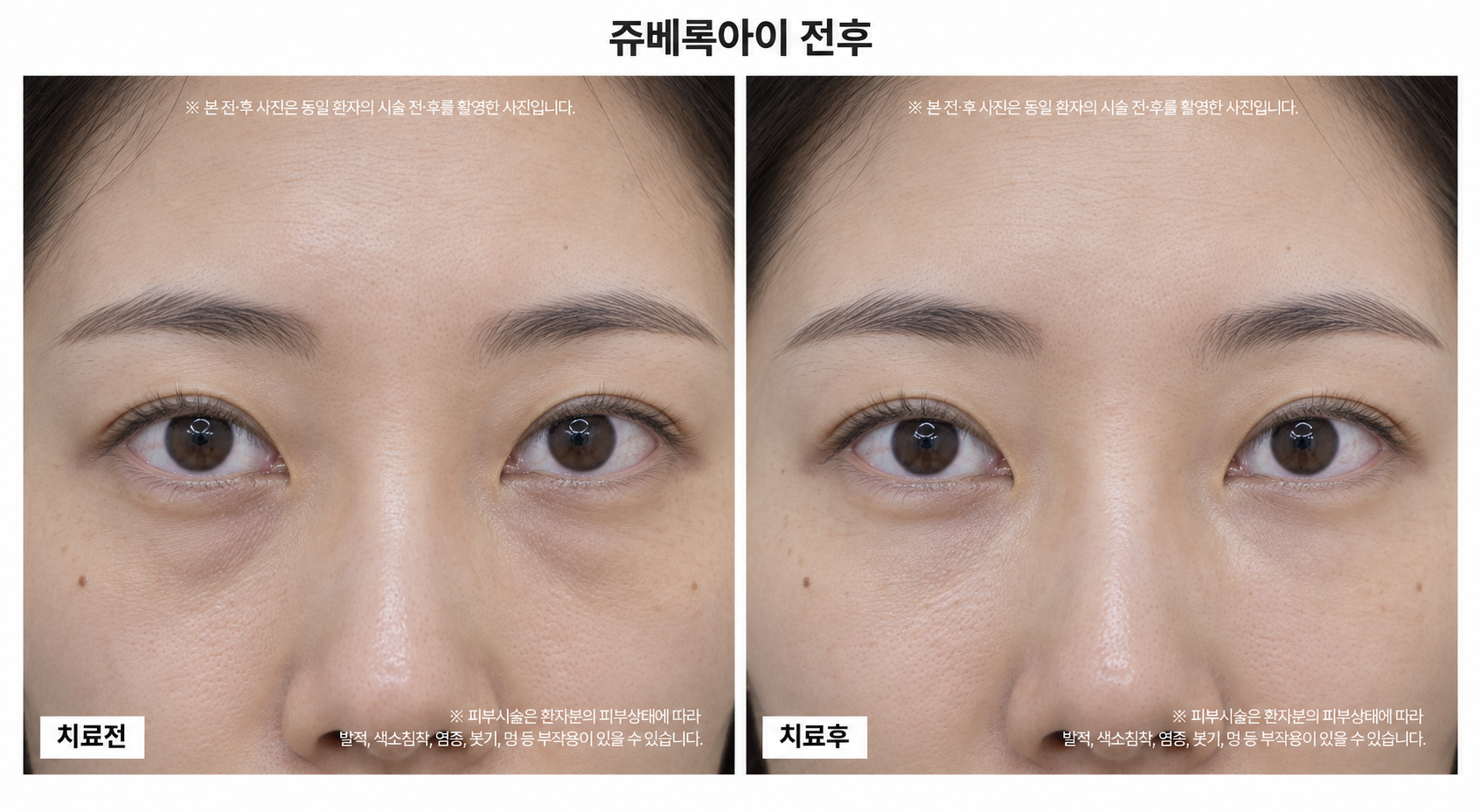 쥬베룩아이 전후사진