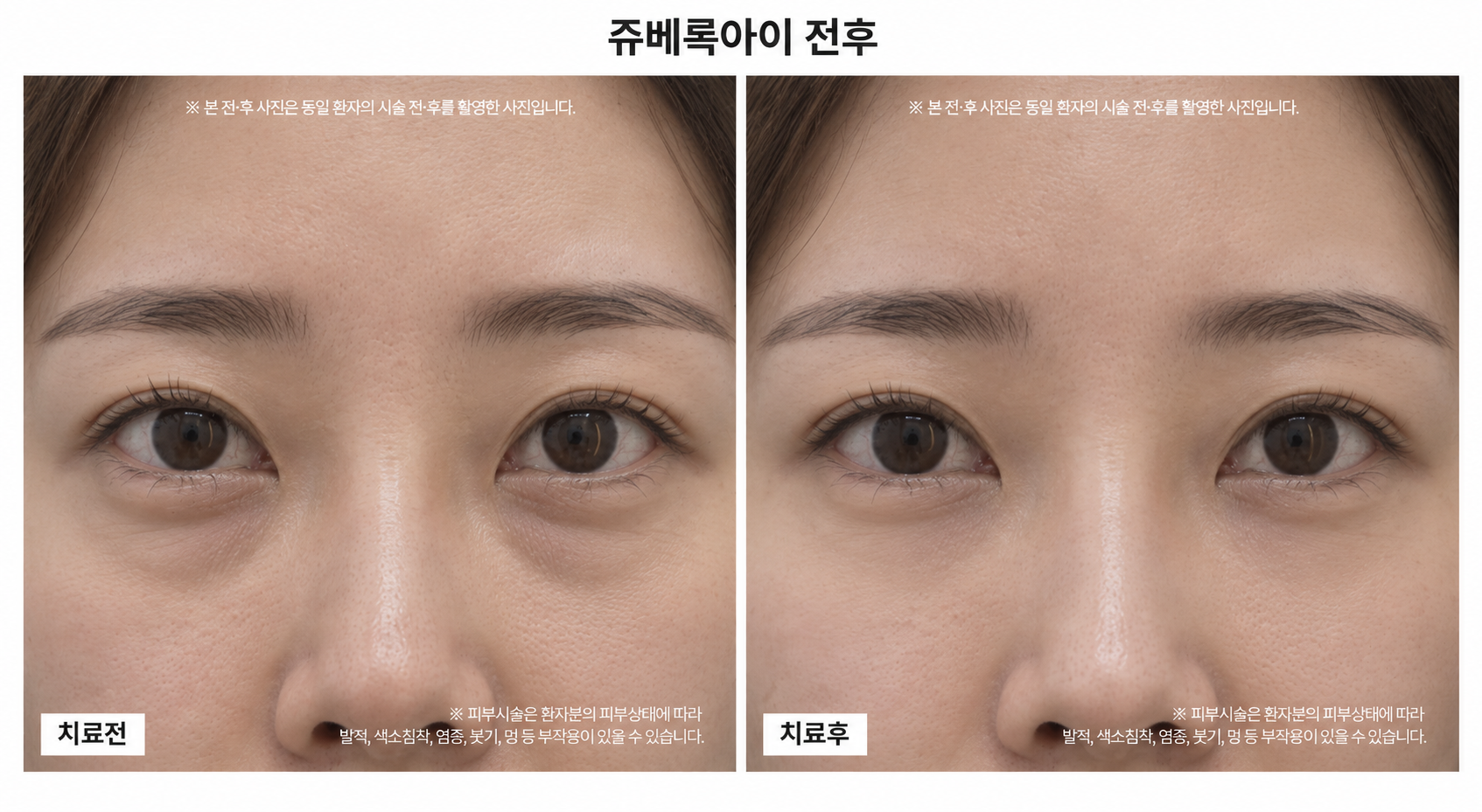 쥬베룩아이 전후사진