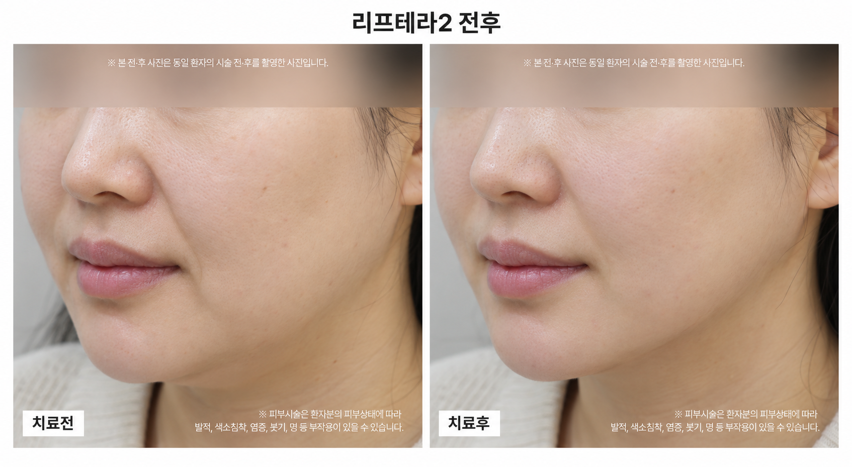 리프팅 시술 전후사진