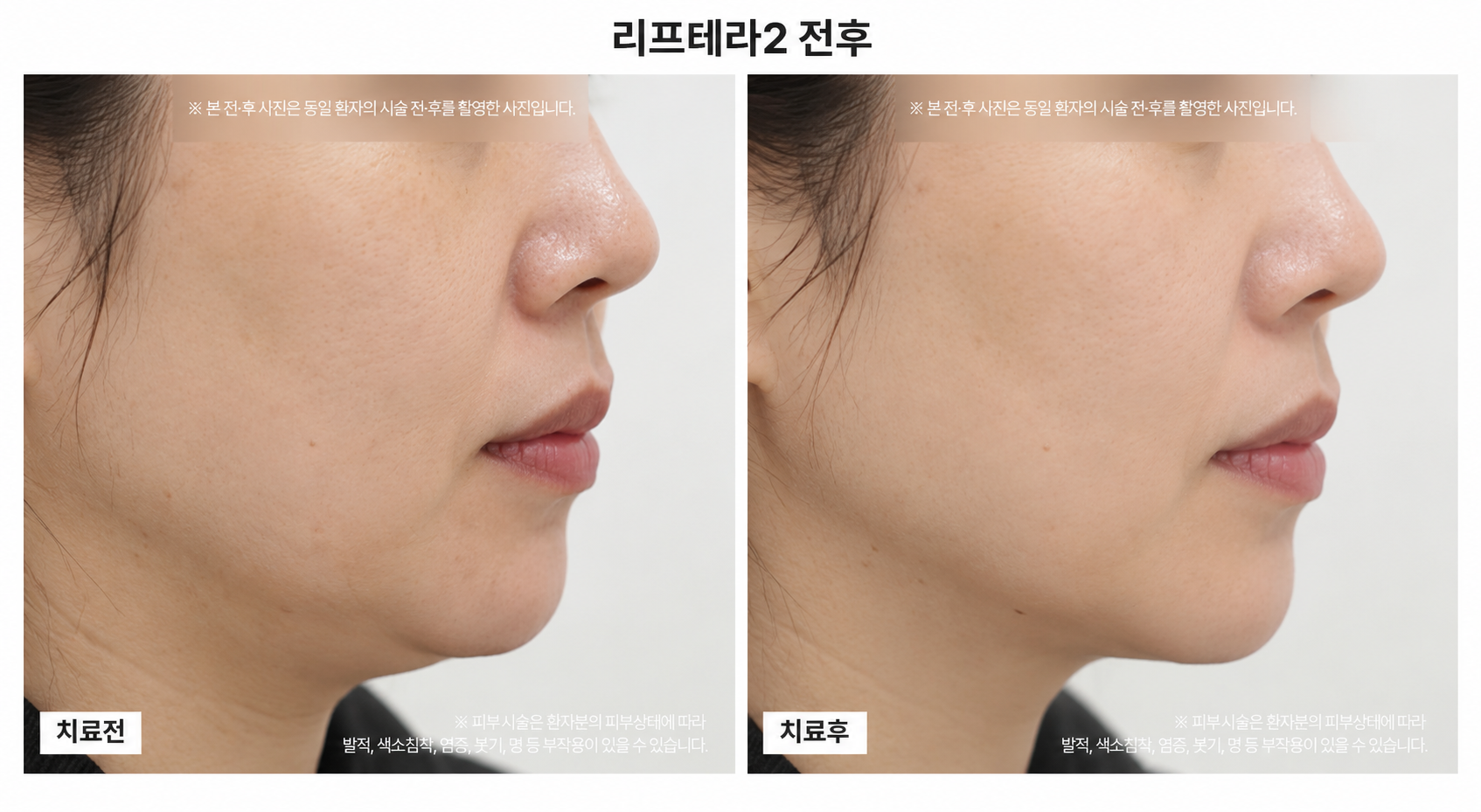 리프팅 시술 전후사진