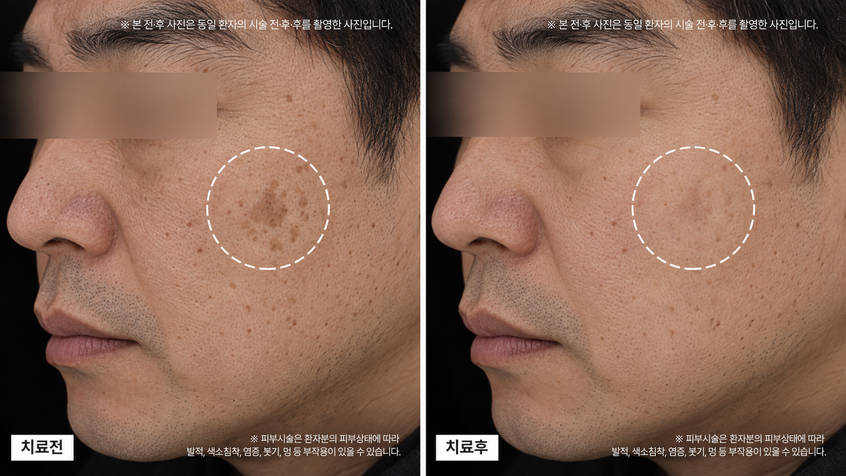 흑자 전후사진