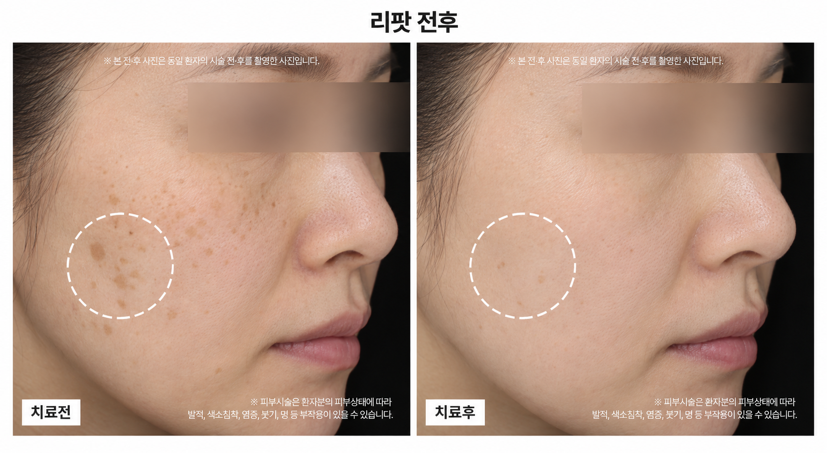 리팟 시술 전후사진
