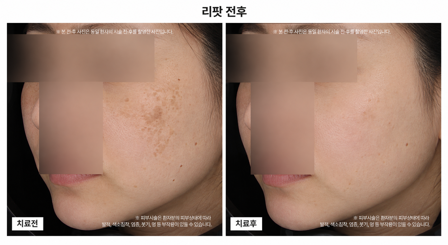 리팟 시술 전후사진