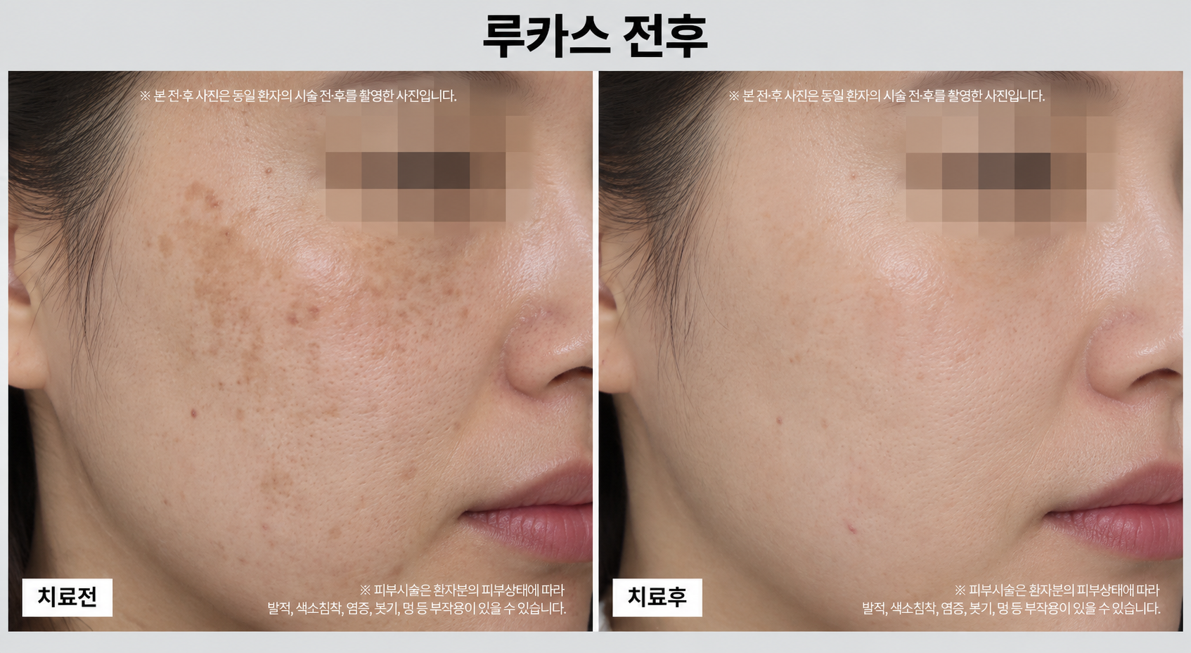 토닝레이저 전후사진