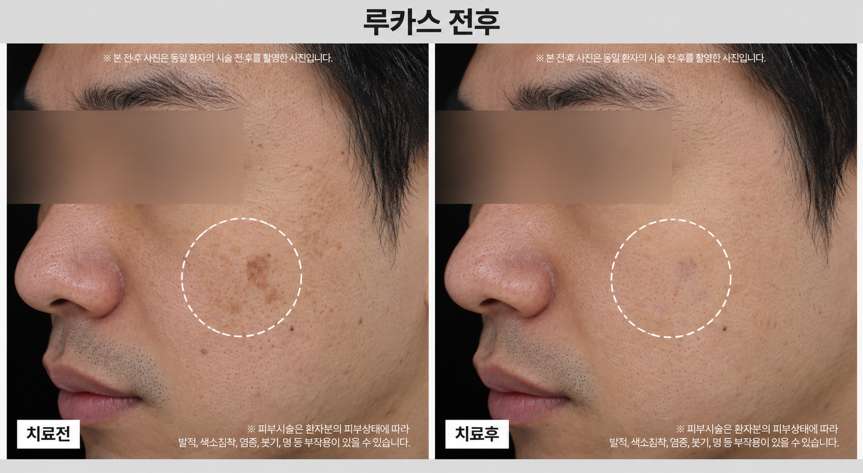 토닝레이저 전후사진