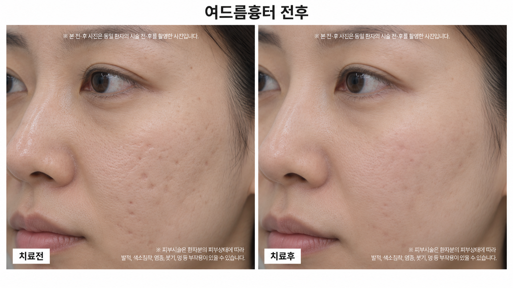 여드름흉터 전후사진