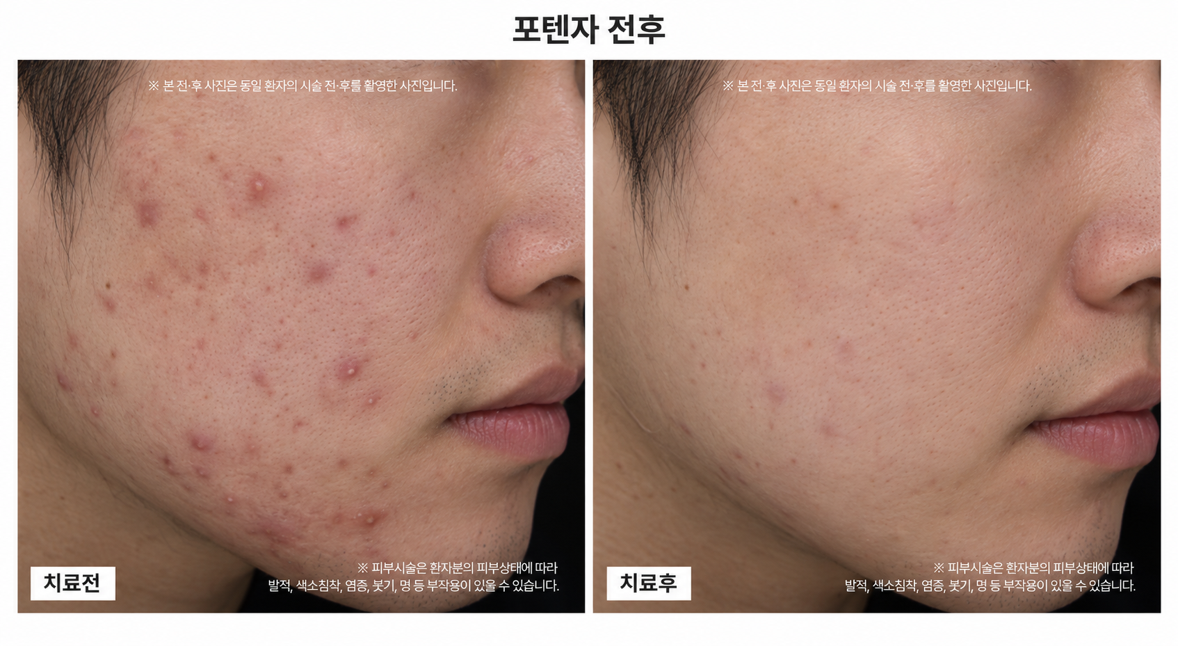 포텐자 시술 전후사진