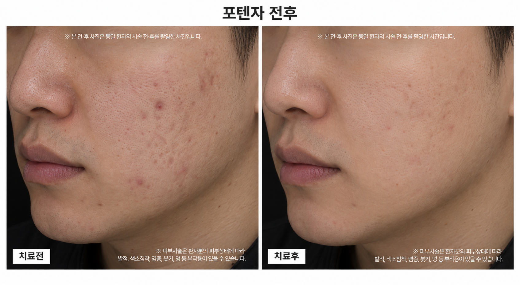 포텐자 시술 전후사진