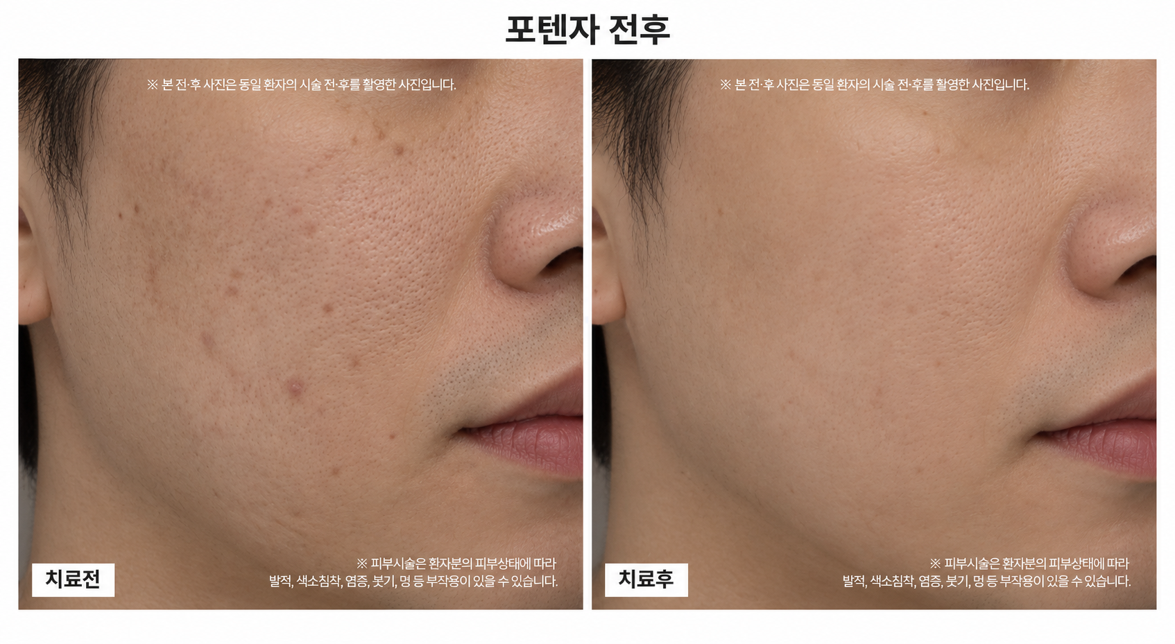 포텐자 시술 전후사진